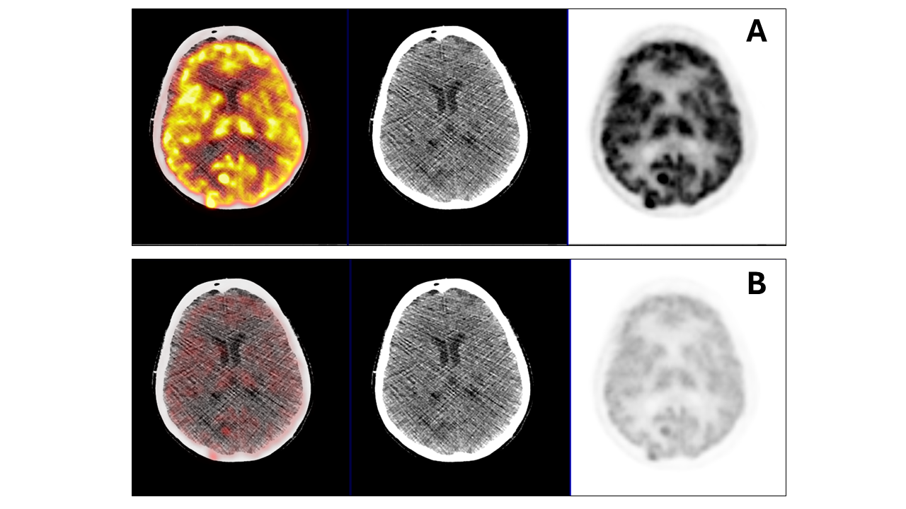 <p>FDG PET/CT Brain Scan Revealing Lesions