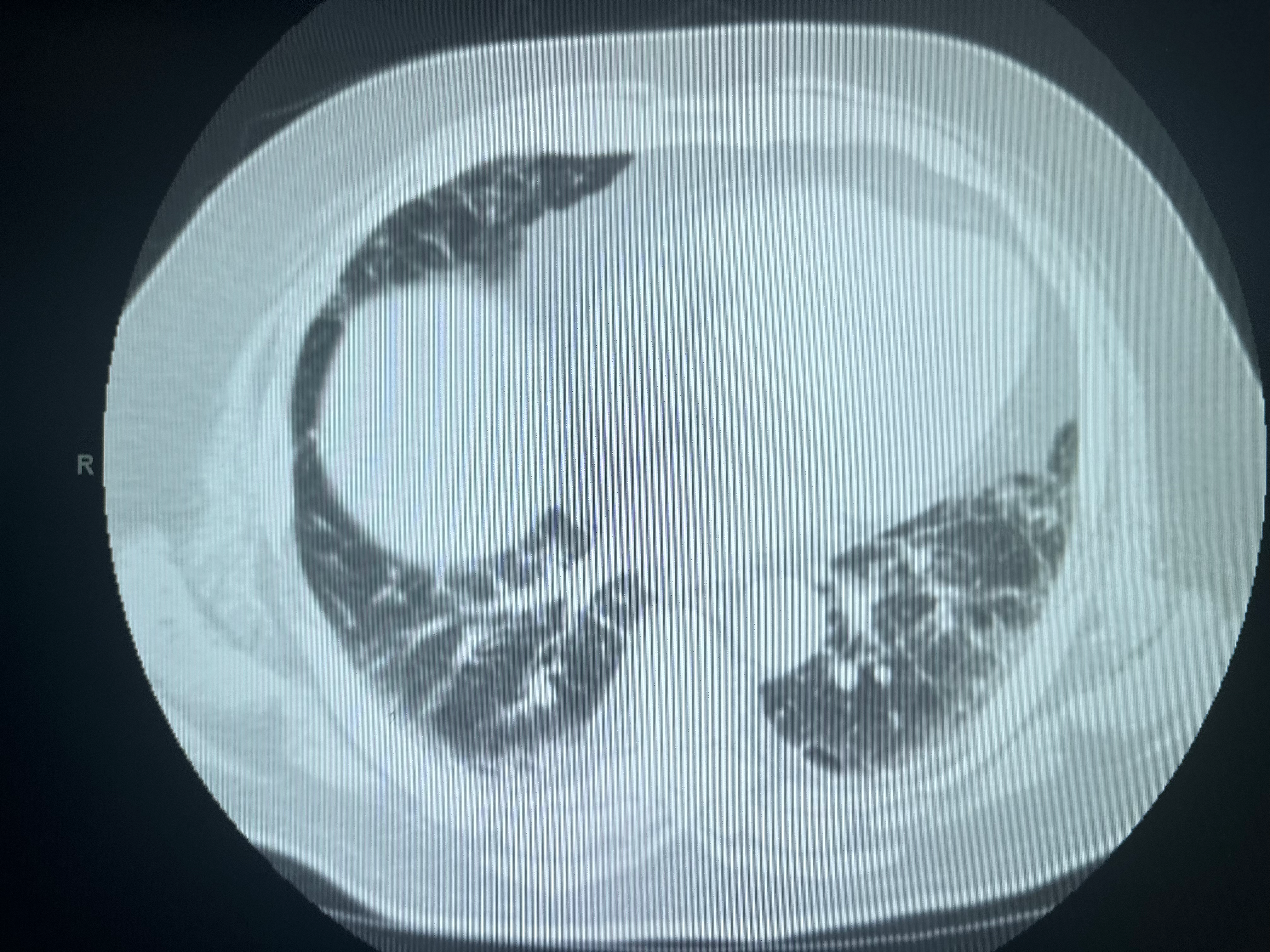 <p>CT Patterns of Probable UIP