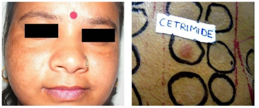 <p>Riehl Melanosis on Bilateral Cheeks