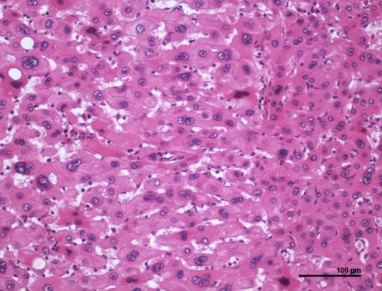 <p>Inflammatory Hepatocellular Adenoma Histopathology