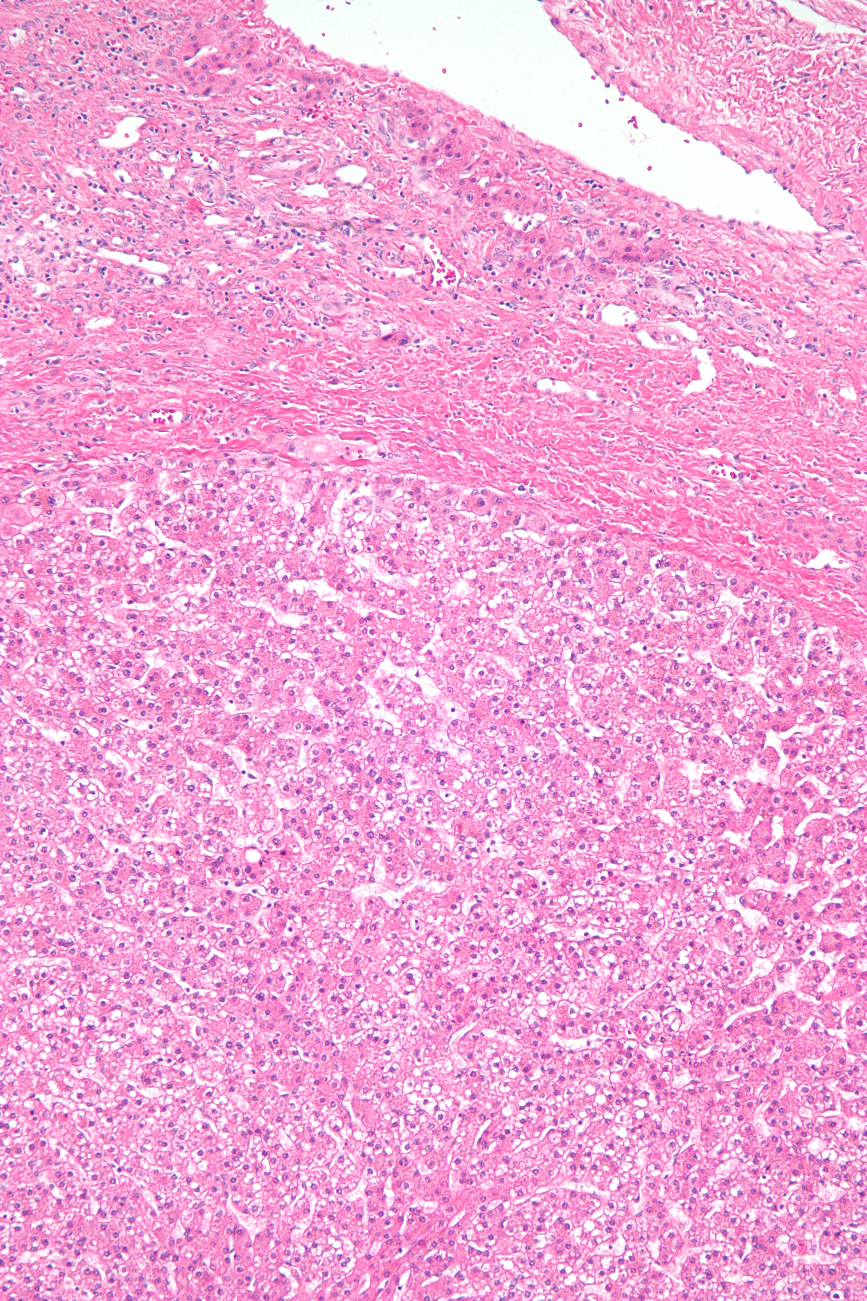 <p>Hepatocellular Adenoma Histopathology