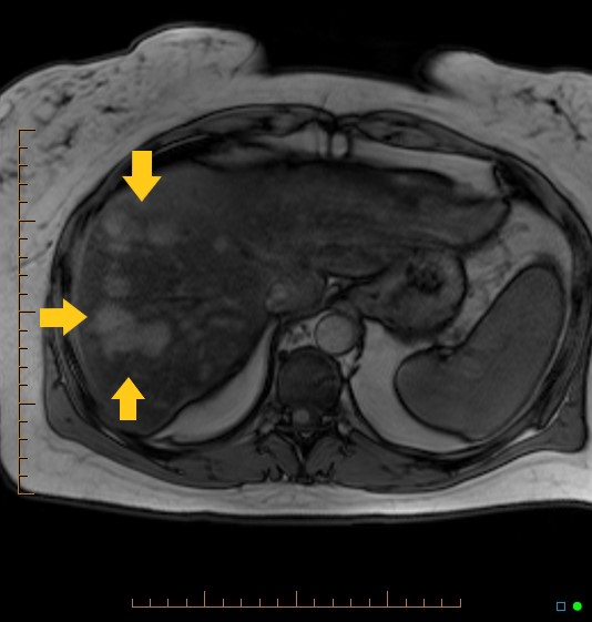 <p>Hepatocellular Adenoma on Magnetic Resonance Imaging