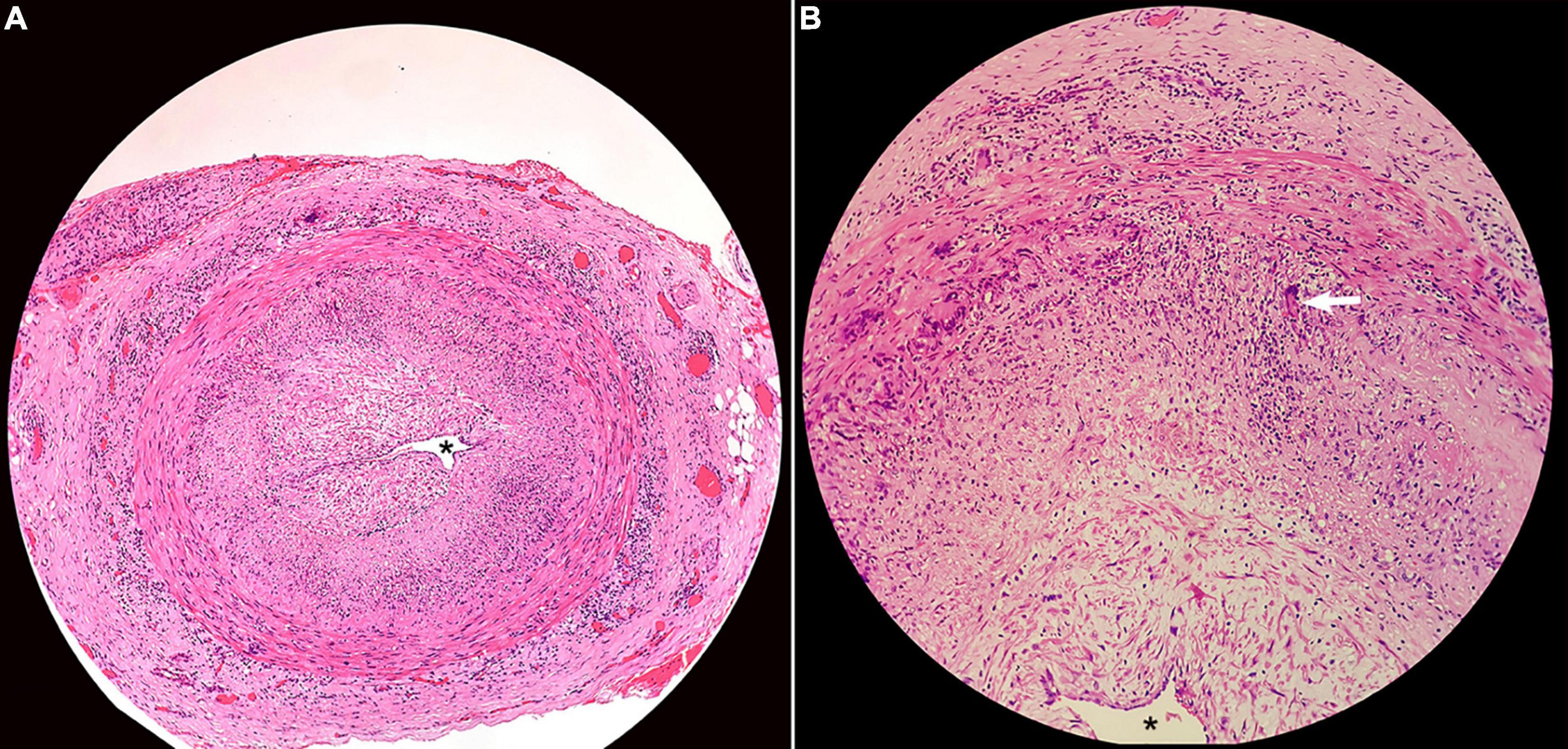 <p>Superficial Temporal Artery Histopathology