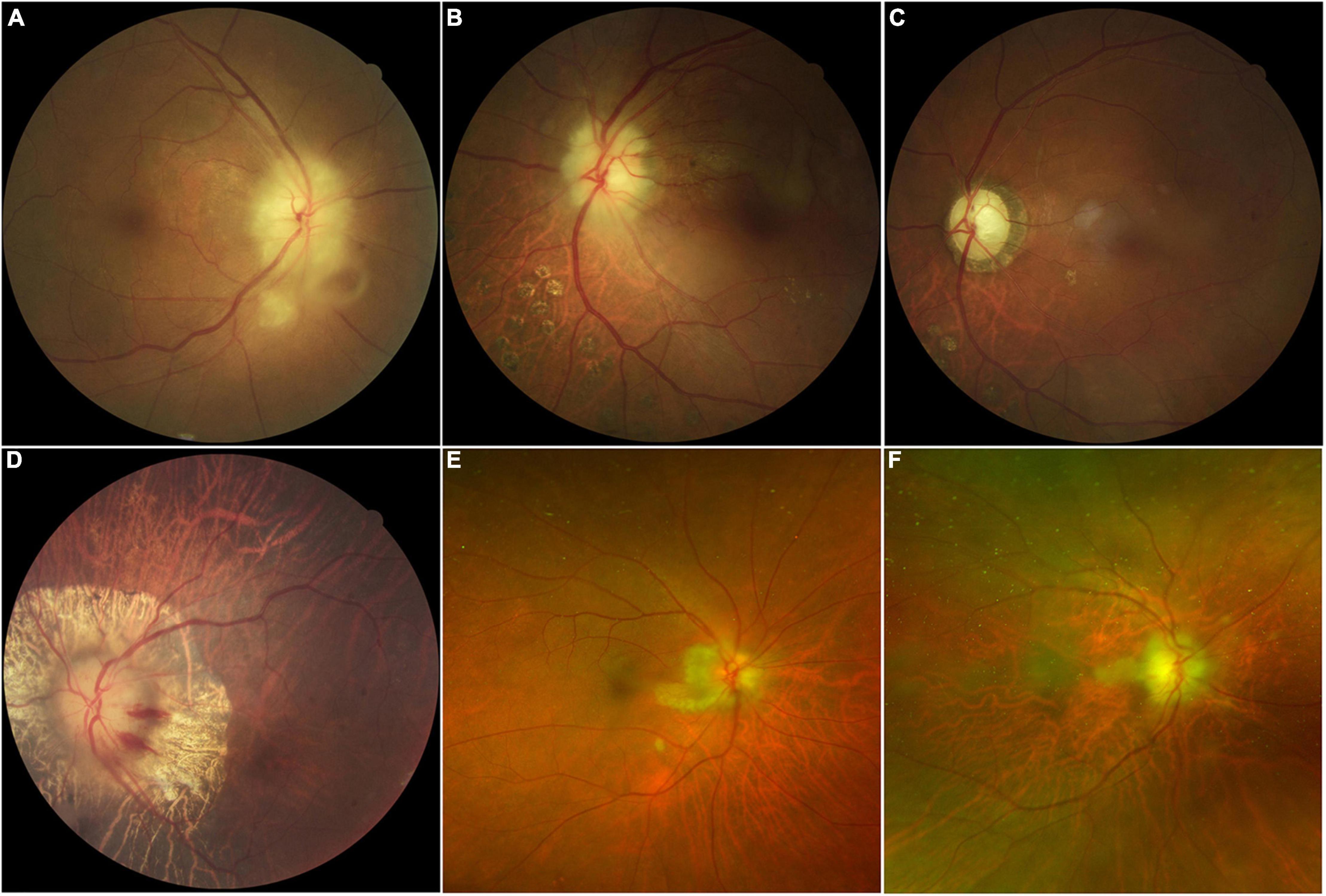 <p>Giant Cell Arteritis Funduscopic Findings