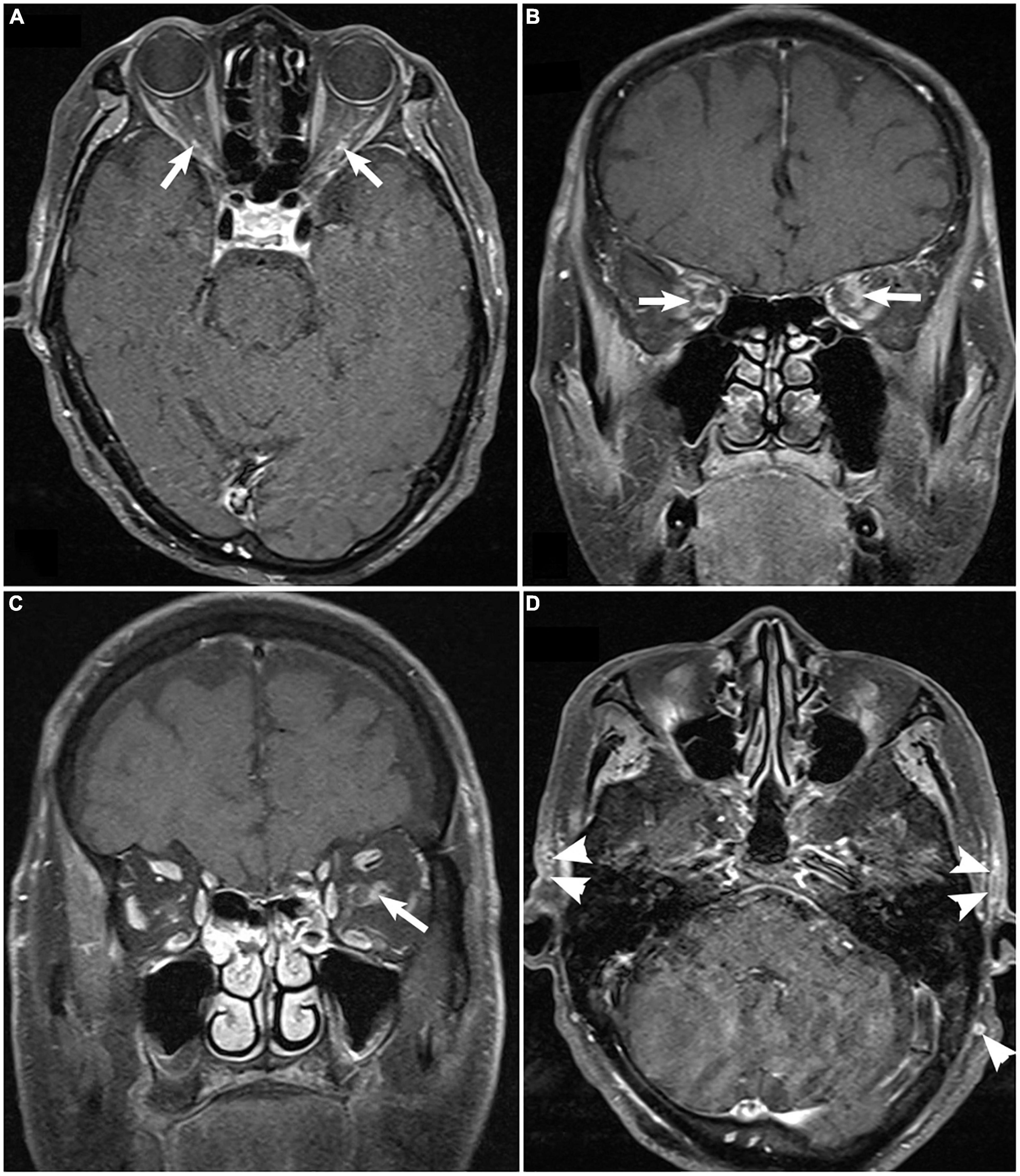 <p>Giant Cell Arteritis on Magnetic Resonance Imaging