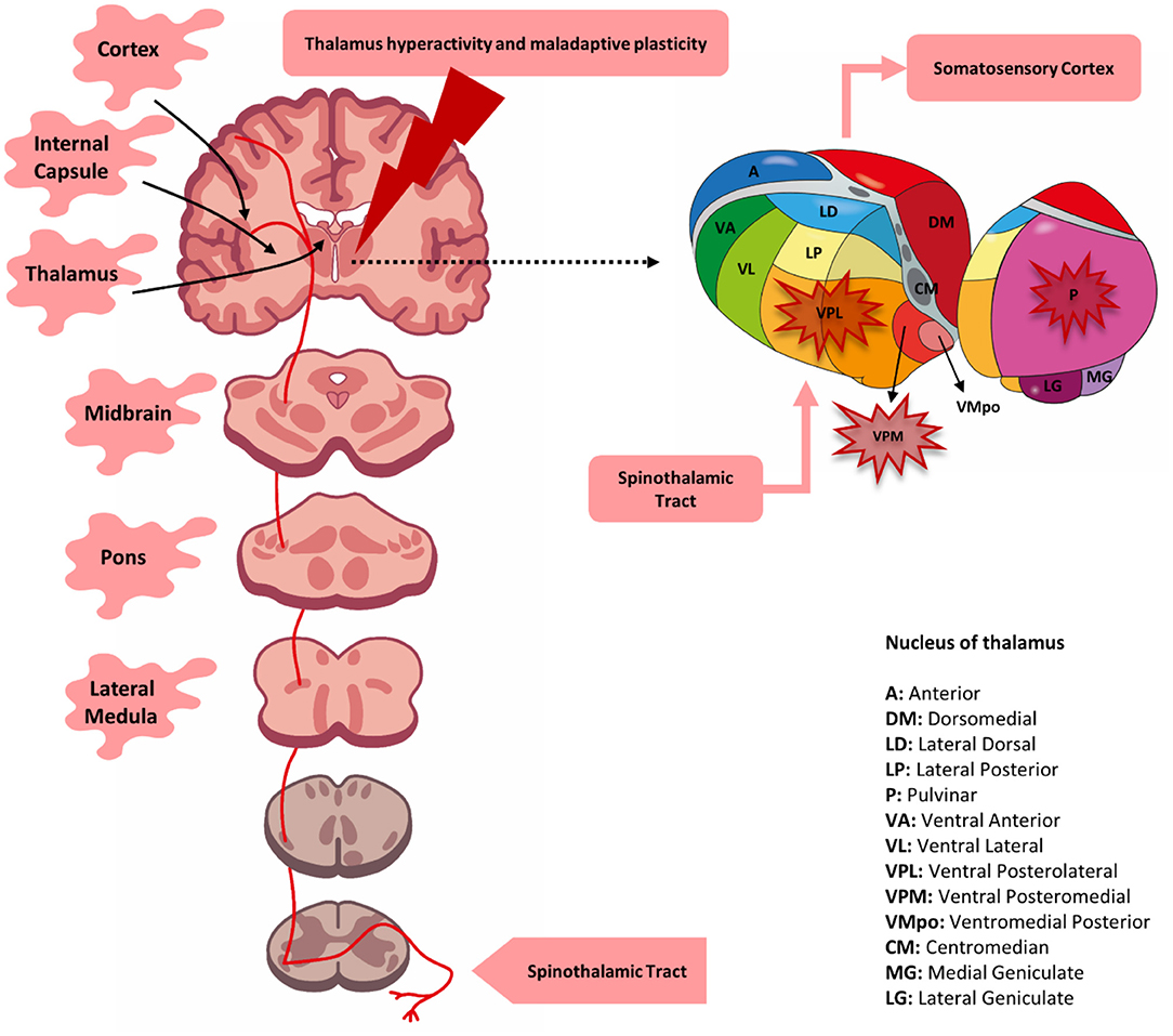 <p>Central Poststroke Pain Syndrome, Potential Sites of Involvement