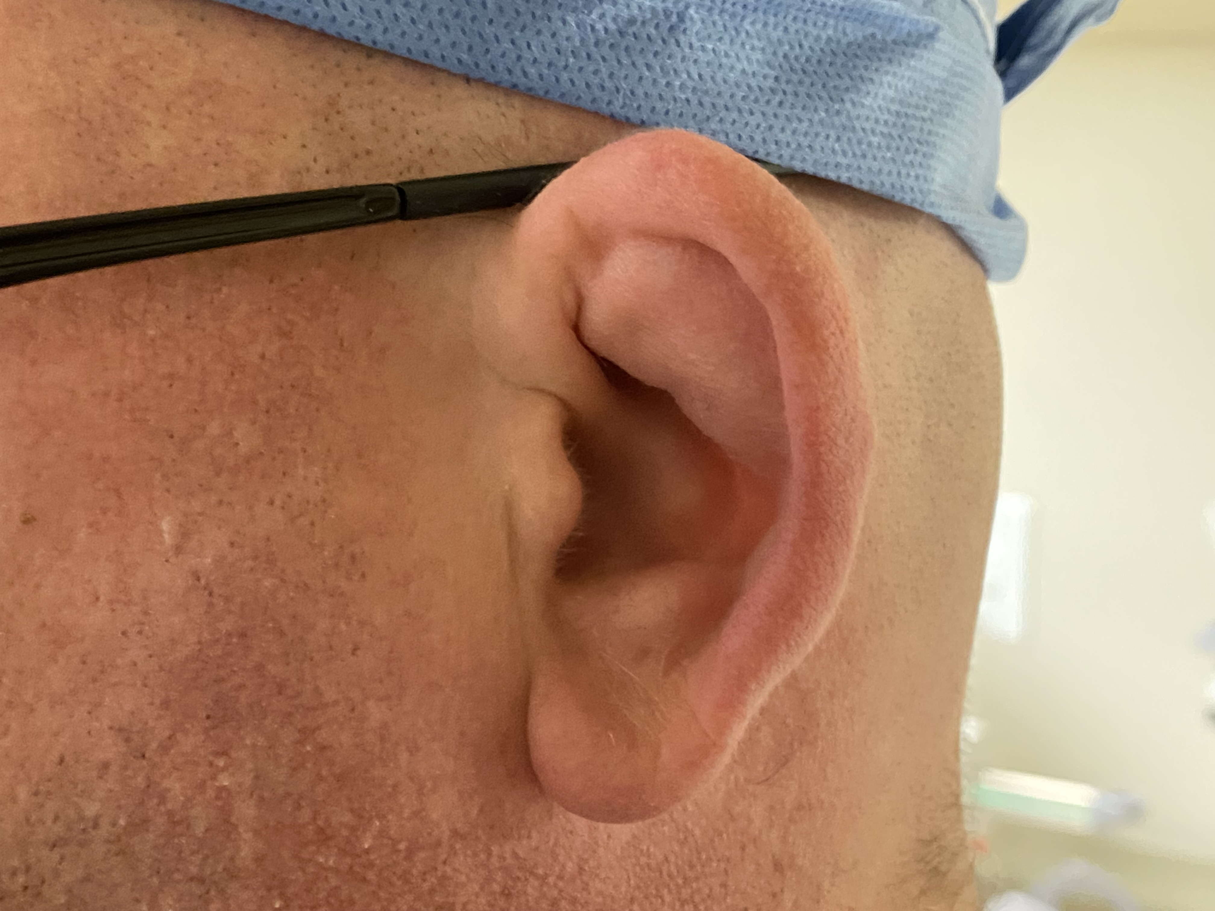 <p>Cauliflower Ear. This image shows a cauliflower ear in a 40-year-old long-time jiu-jitsu practitioner.</p>