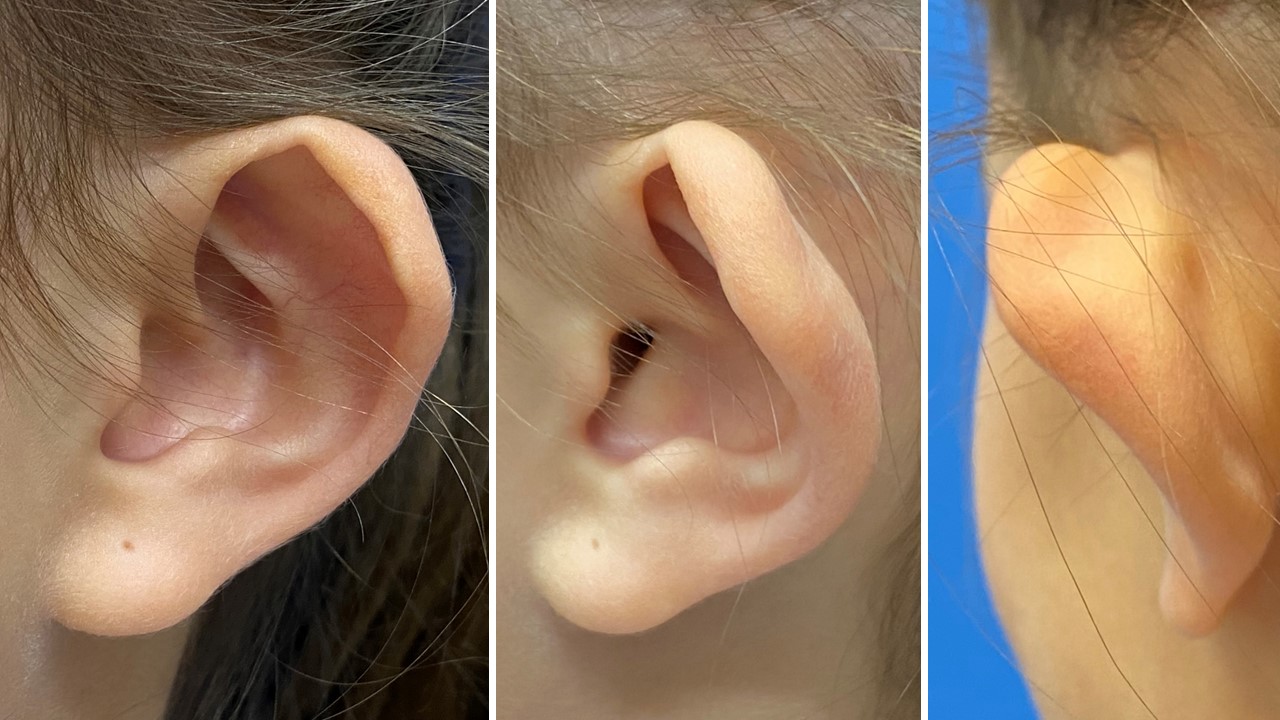 <p>Lop Ear Deformity