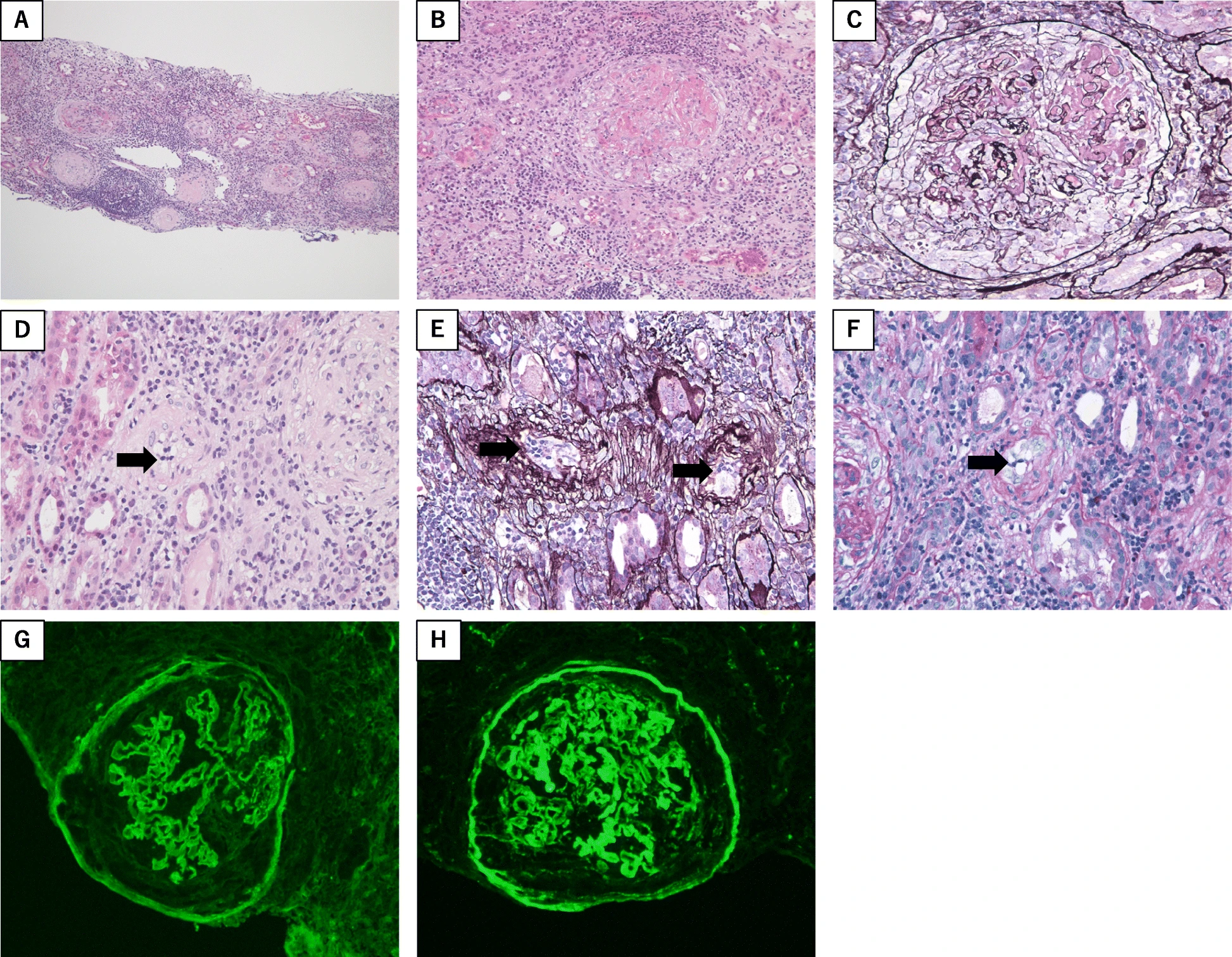 <p><strong>Rapidly Progressive Glomerulonephritis