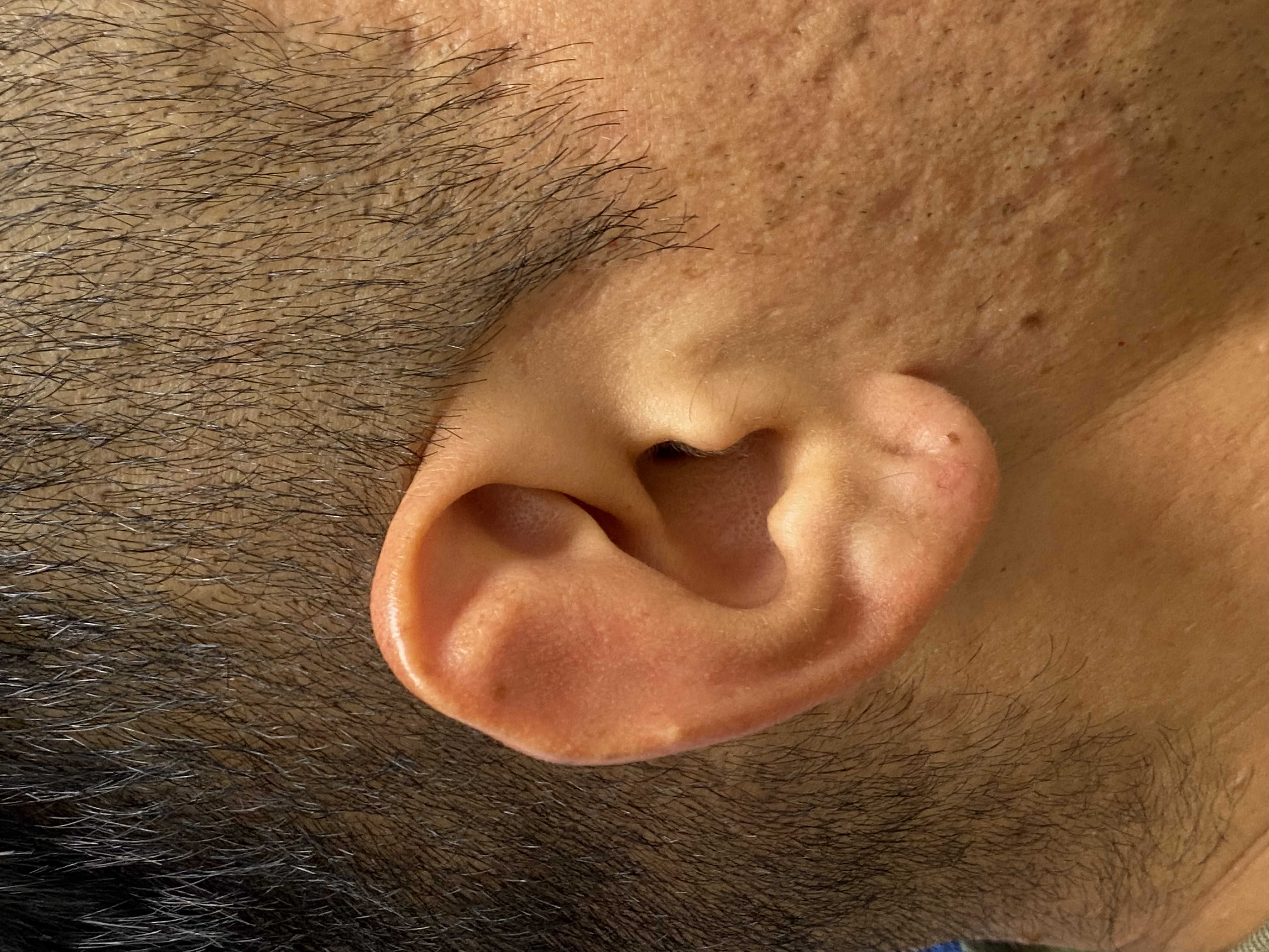 <p>Stahl Ear Deformity