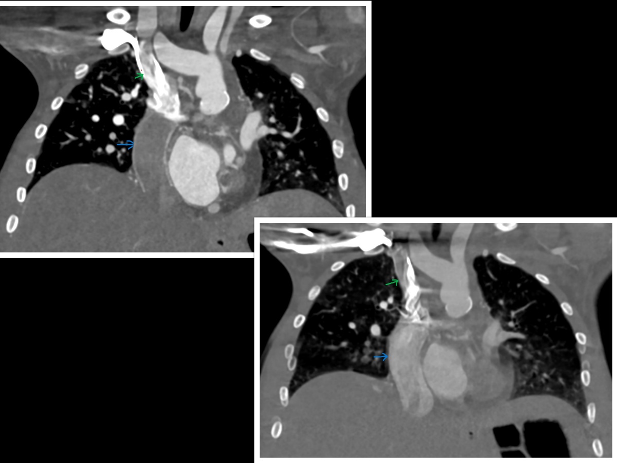 <p>Completed Fontan on Cardiac Computed Tomography