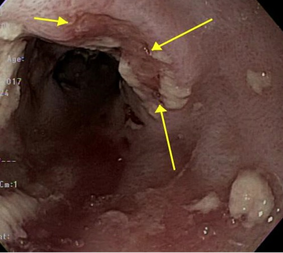 <p>Esophageal Histoplasmosis