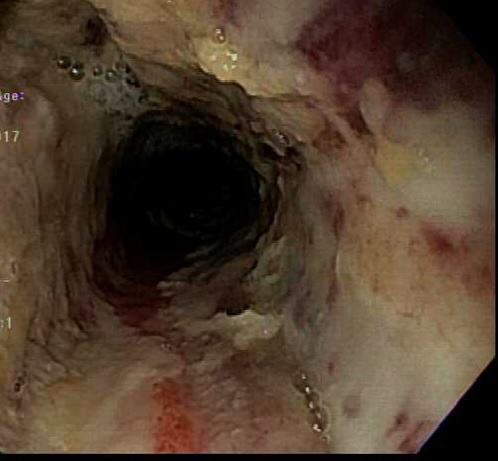 <p>Caustic Ingestion on Endoscopy. This image shows severe esophagitis and esophageal ulcerations from caustic ingestion.</p>