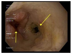 <p>Esophageal Fistula