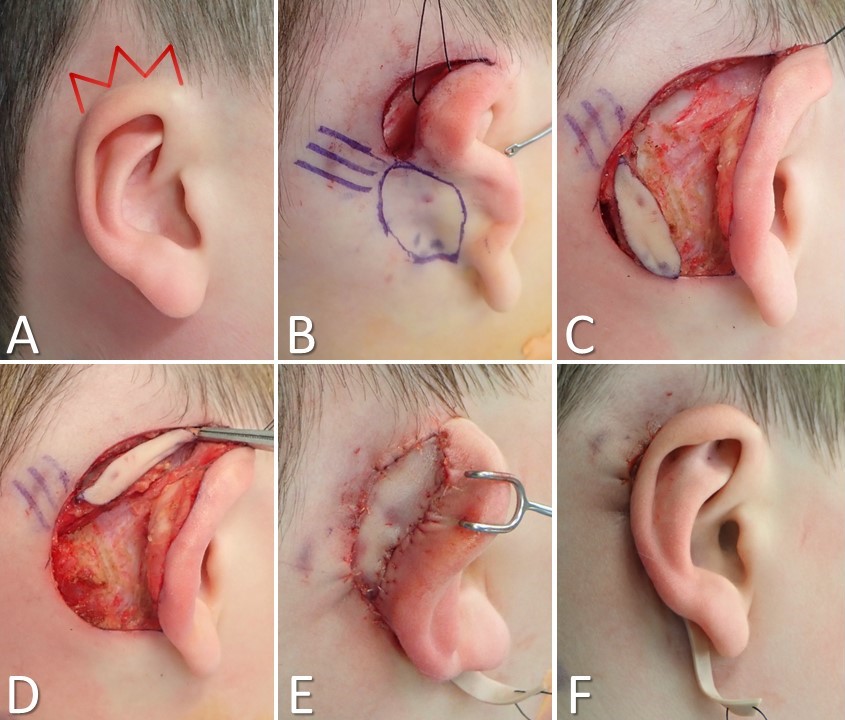 <p>Cryptotia Reconstruction