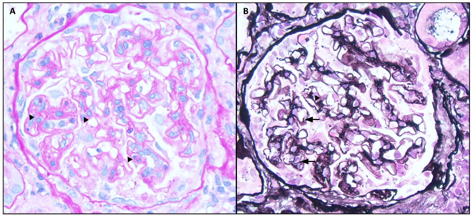 <p>Membranoproliferative Pattern of Injury: PAS and Jones Stains