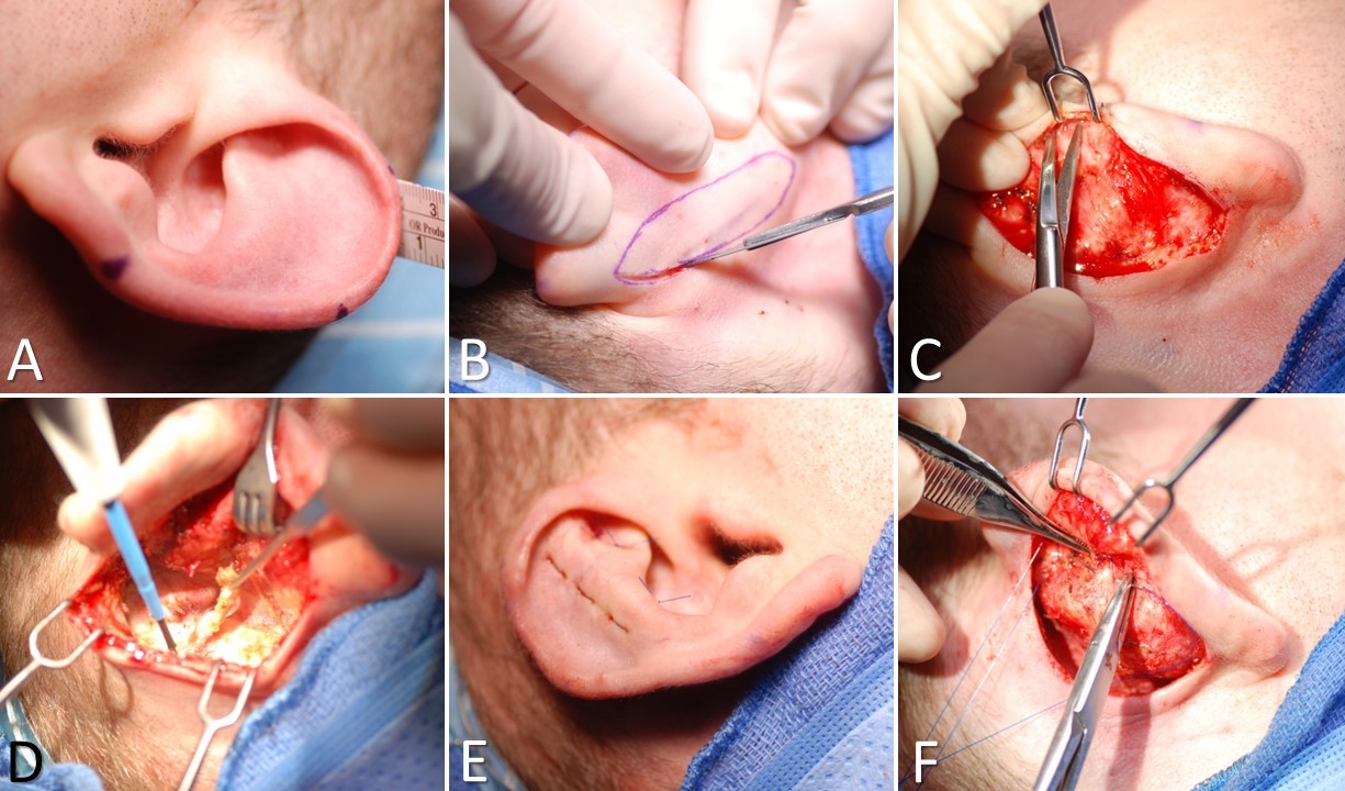 <p>Otoplasty for Prominauris, Part 1