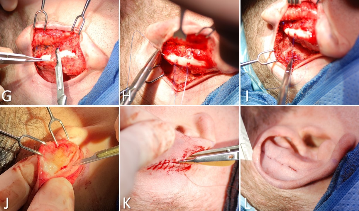 <p>Otoplasty for Prominauris, Part 2