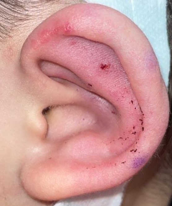 <p>Postoperative Perichondritis