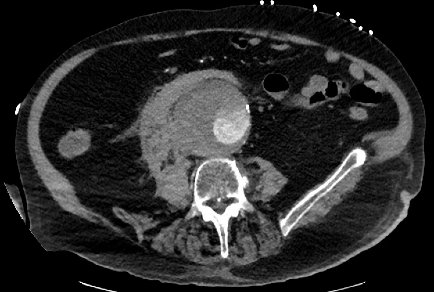 <p>Ruptured Infrarenal Abdominal Aortic Aneurysm, Computed Tomography Angiogram
