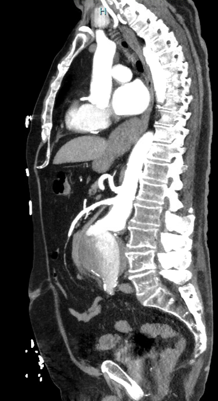 <p>Infrarenal Abdominal Aortic Aneurysm, Computed Angiogram