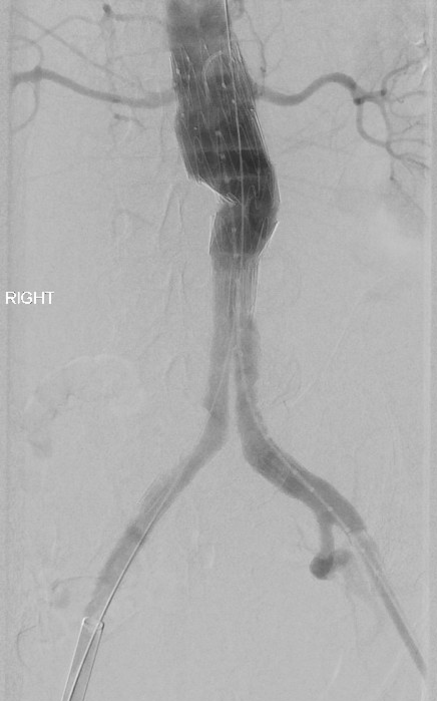 <p>Completion Aortigram after repair of ruptured 7