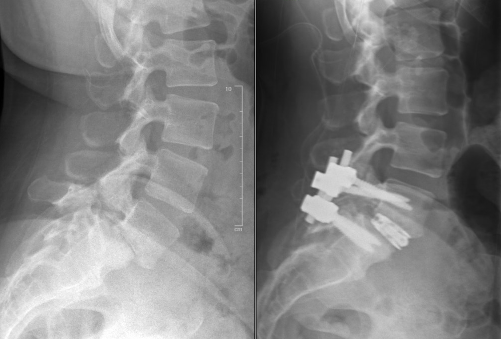 <p>Transforaminal Lumbar Fusion