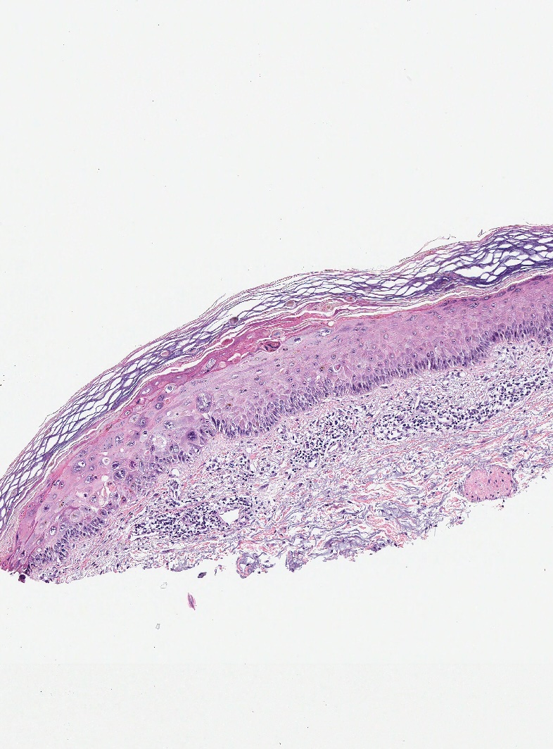 <p>Histopathology of Necrolytic Acral Erythema
