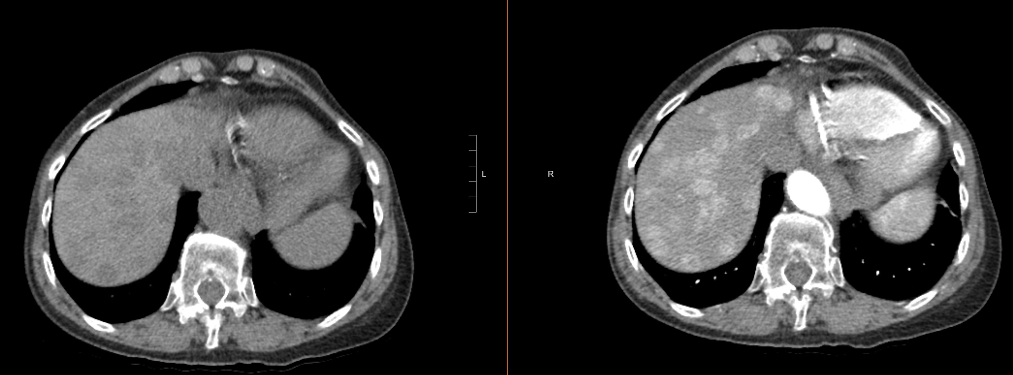 <p>Neuroendocrine Tumor Liver Metastases