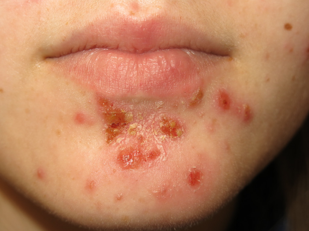 <p>Impetigo, Skin Infection</p>