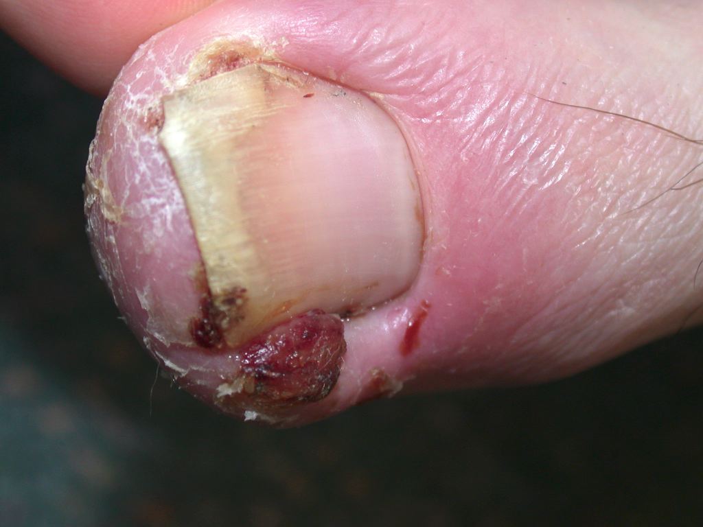 <p>Ingrown Toenail