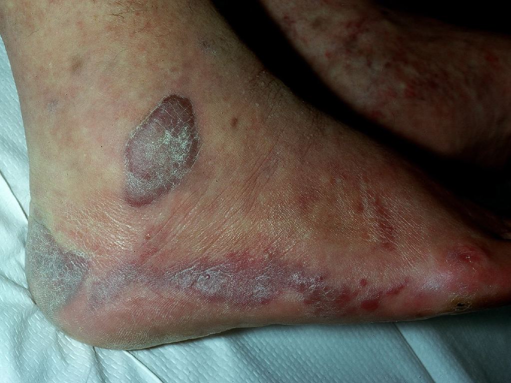 <p>Kaposi Sarcoma</p>