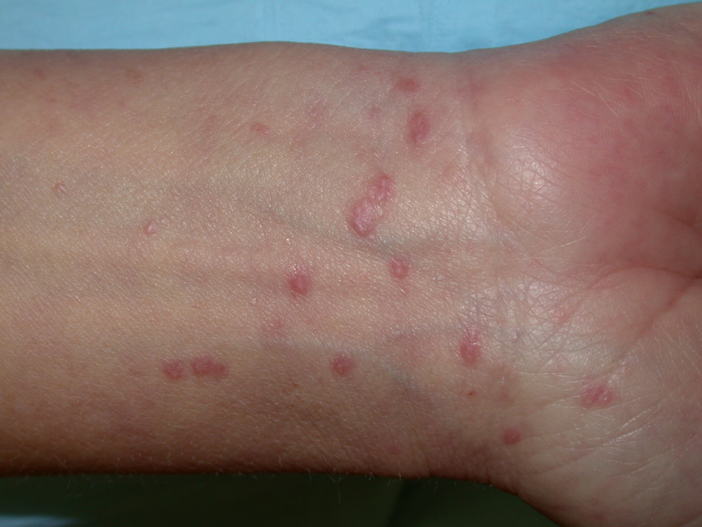 <p>Lichen Planus</p>