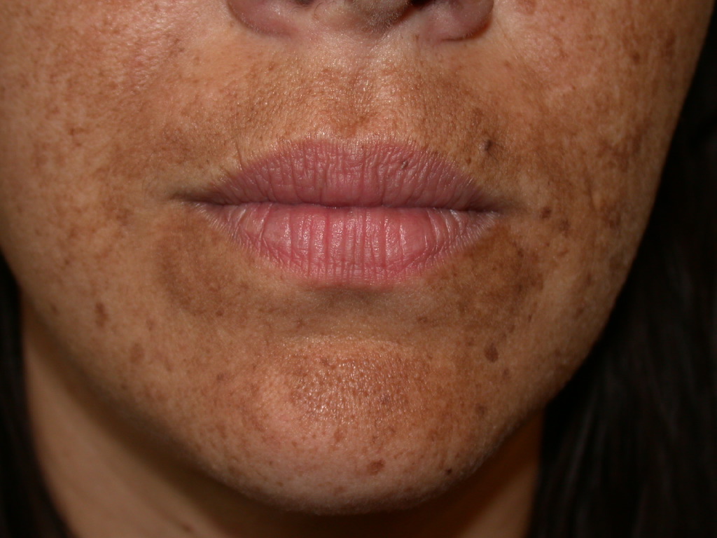 <p>Melasma, Face</p>