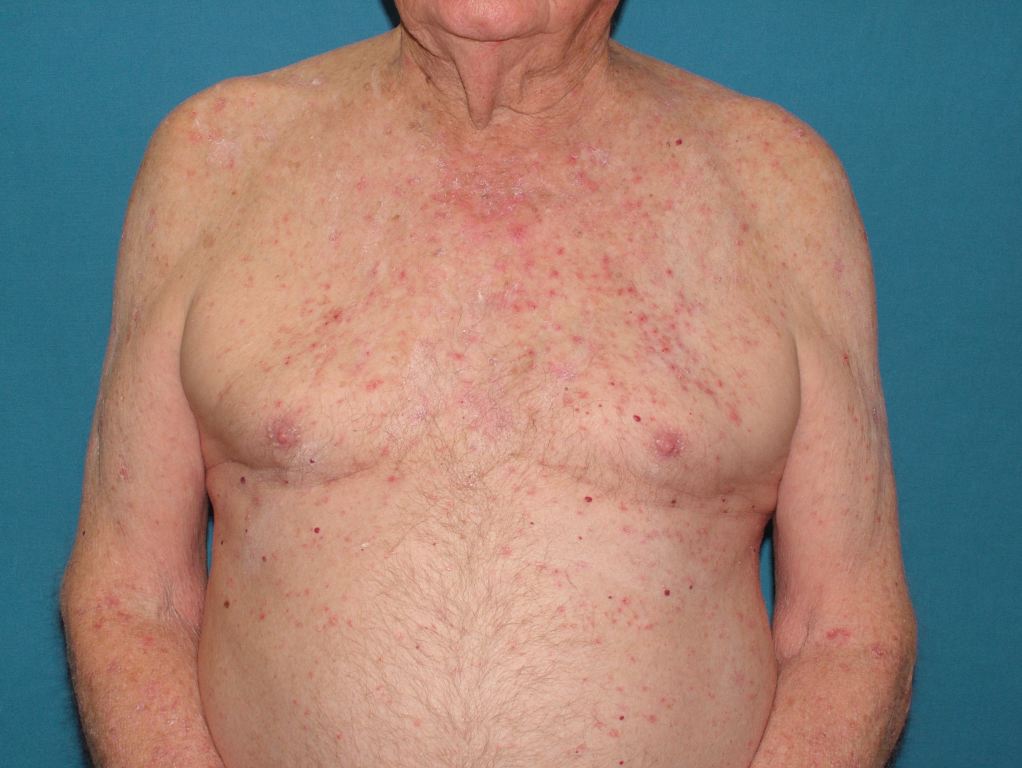 <p>Miliaria, Skin Disease</p>