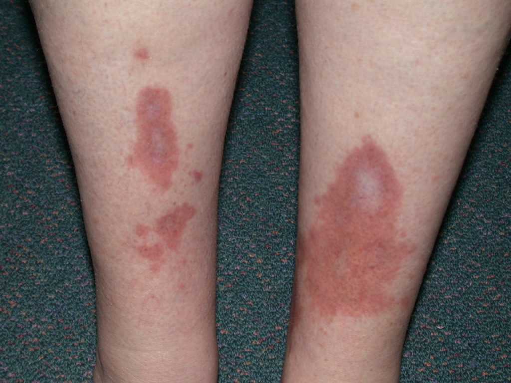 <p>Necrobiosis Lipoidica, Lower&nbsp;Extremities</p>