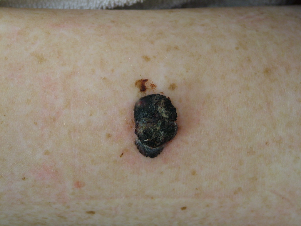 <p>Nodular Melanoma</p>