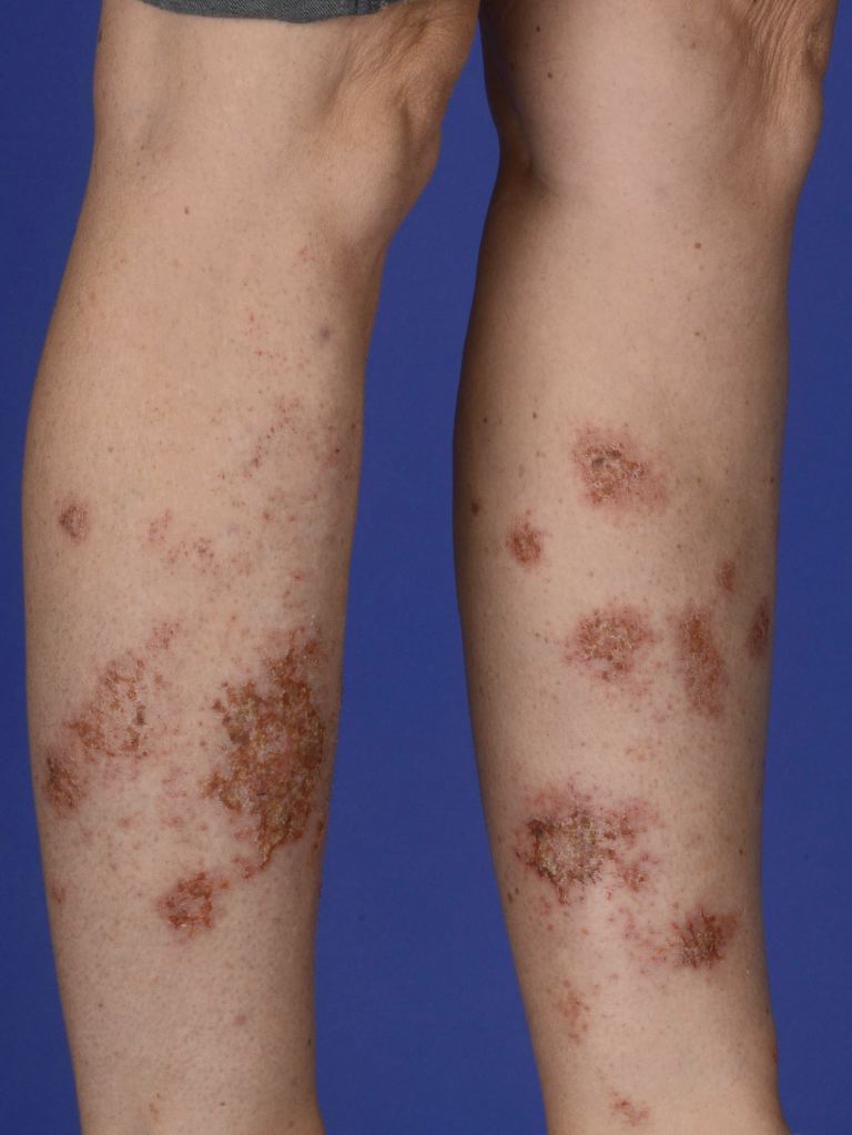 <p>Nummular Dermatitis</p>