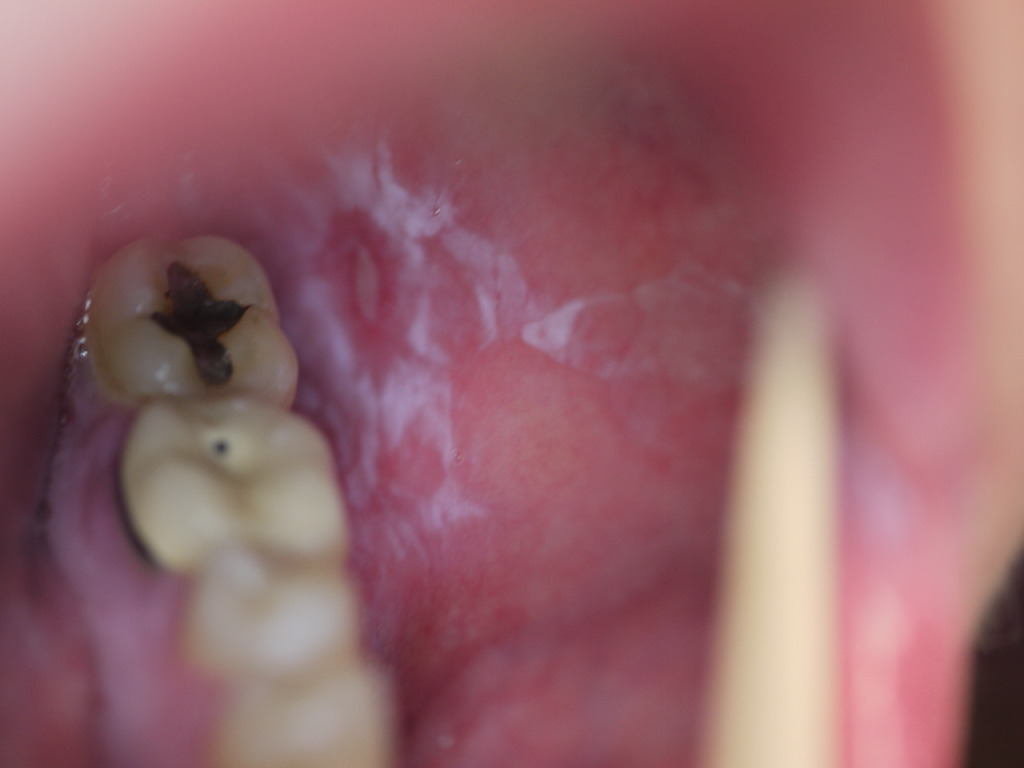 <p>Oral Lichen Planus</p>