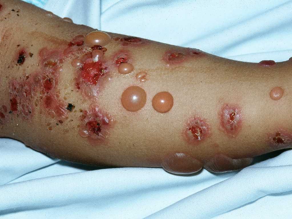 <p>Bullous Pemphigoid</p>