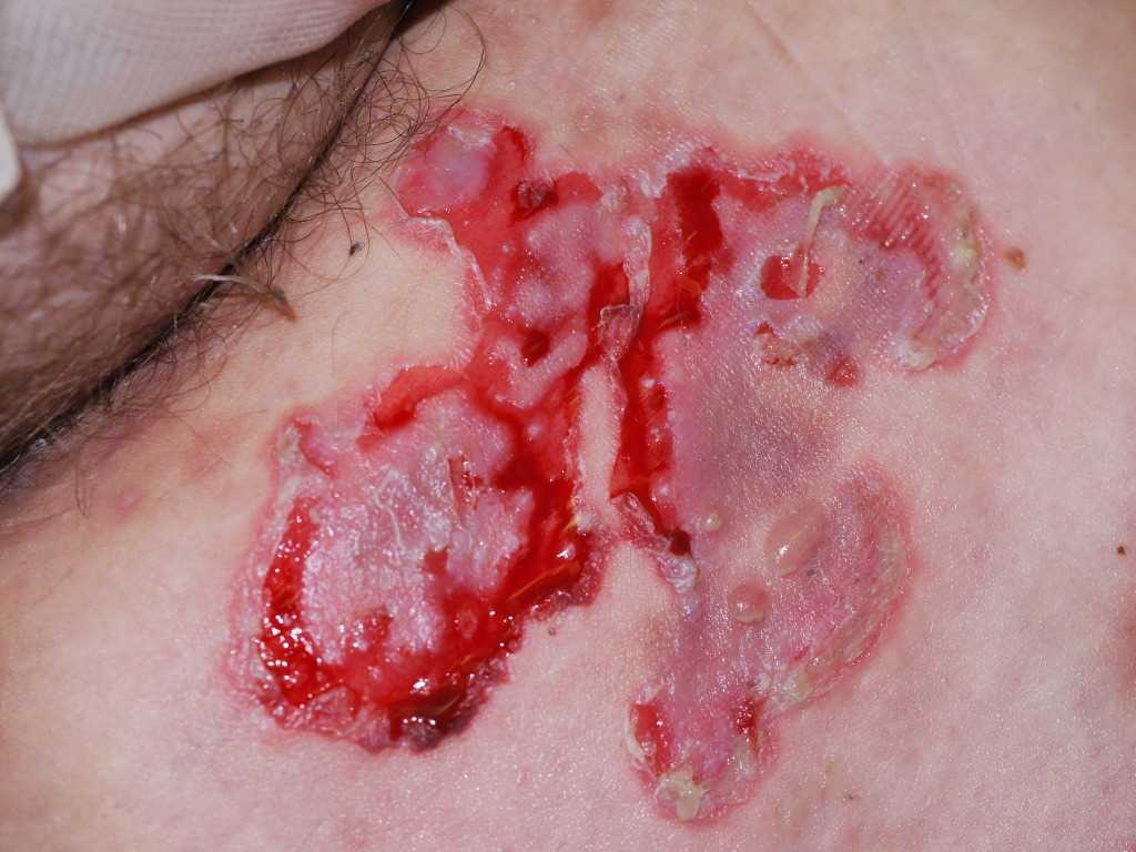 <p>Pemphigus Vulgaris</p>