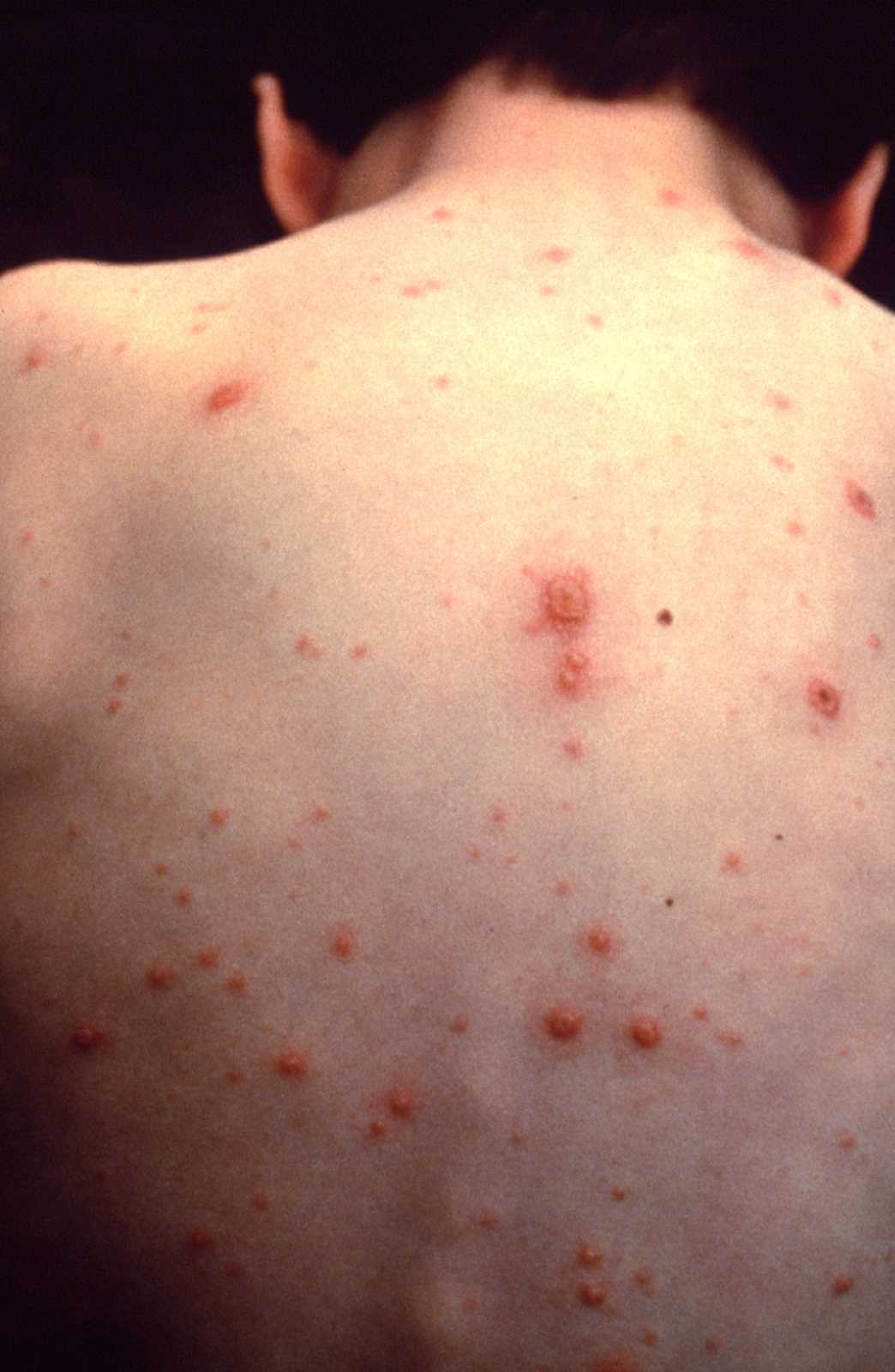 <p>Chickenpox (Varicella). Chickenpox is seen in an unvaccinated child.</p>