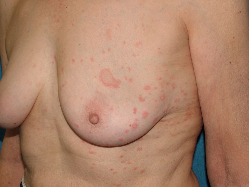 <p>Pityriasis Rosea</p>