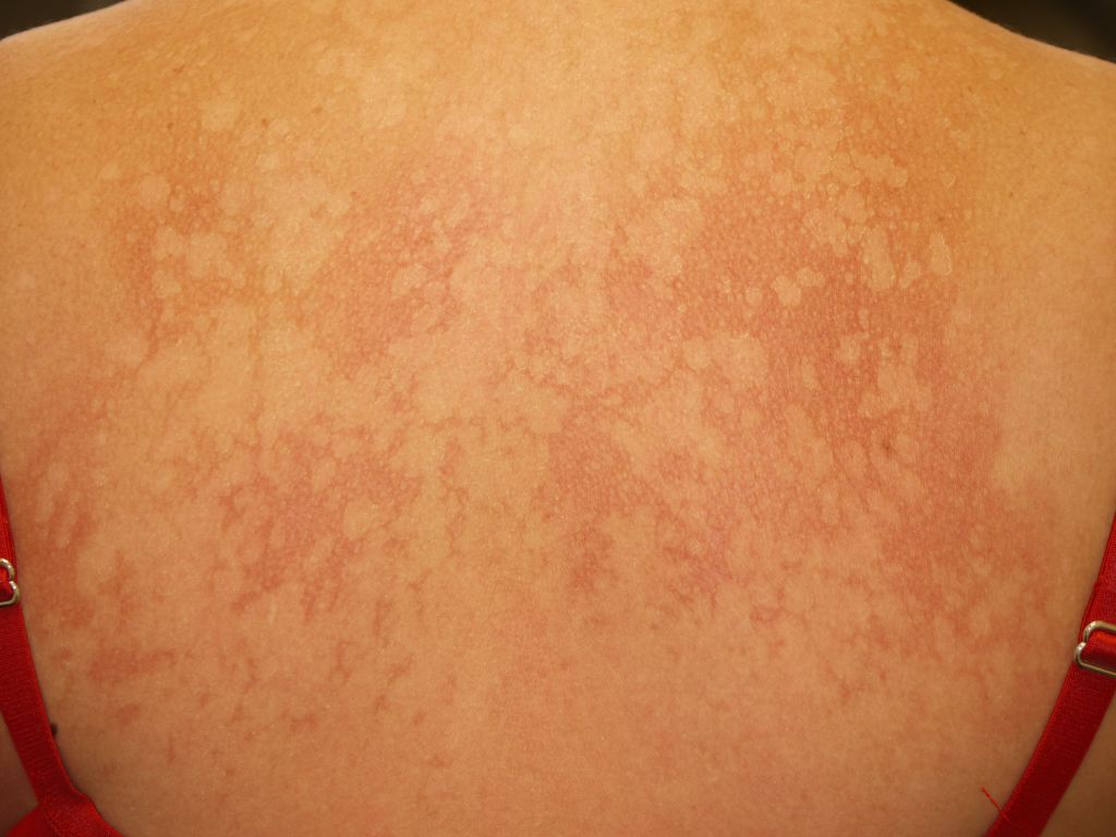 <p>Pityriasis Versicolor</p>