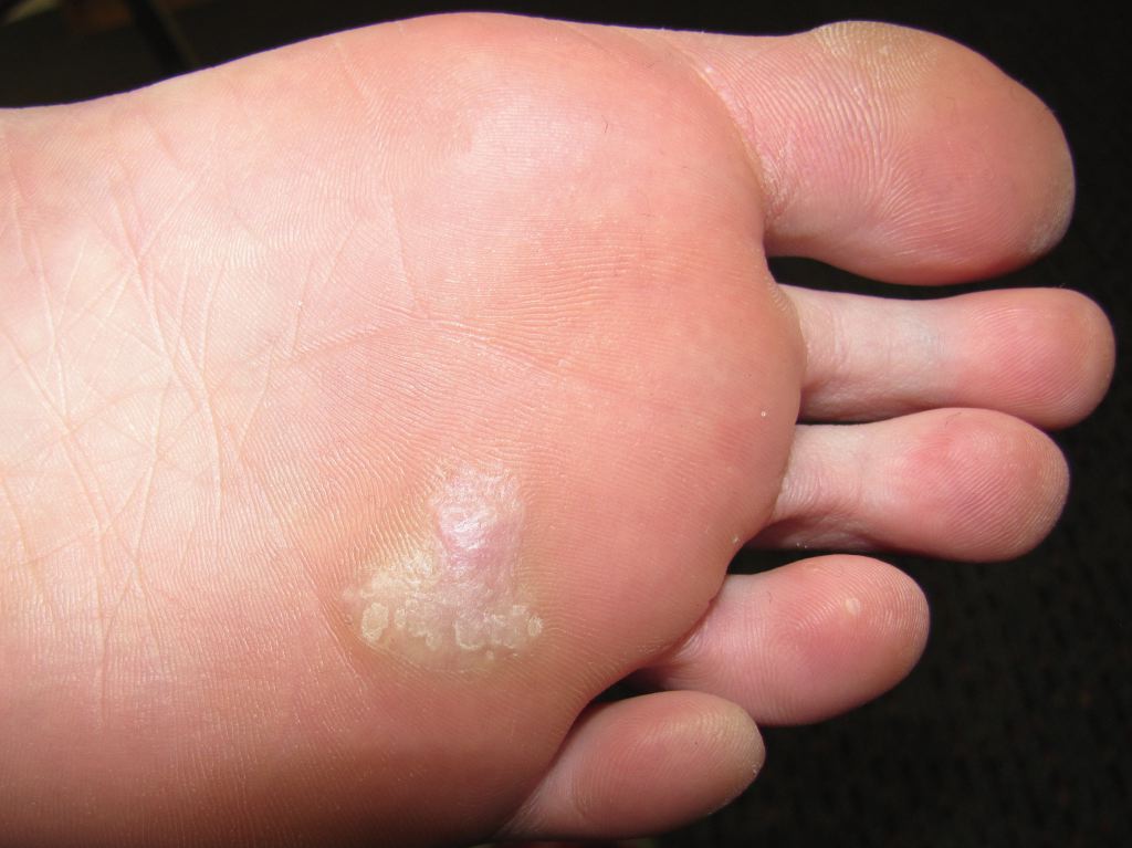 <p>Plantar Wart</p>