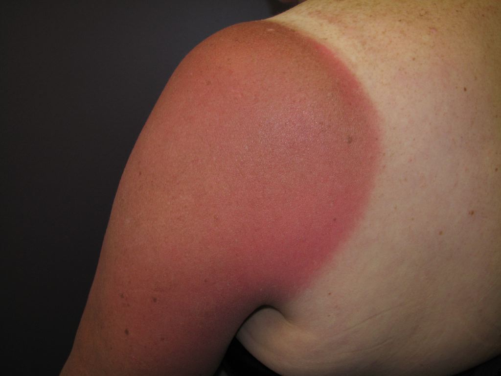 <p>Sunburn, Shoulder</p>