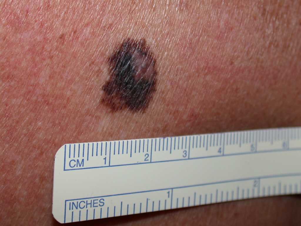 <p>Melanoma</p>
<p>&nbsp;</p>