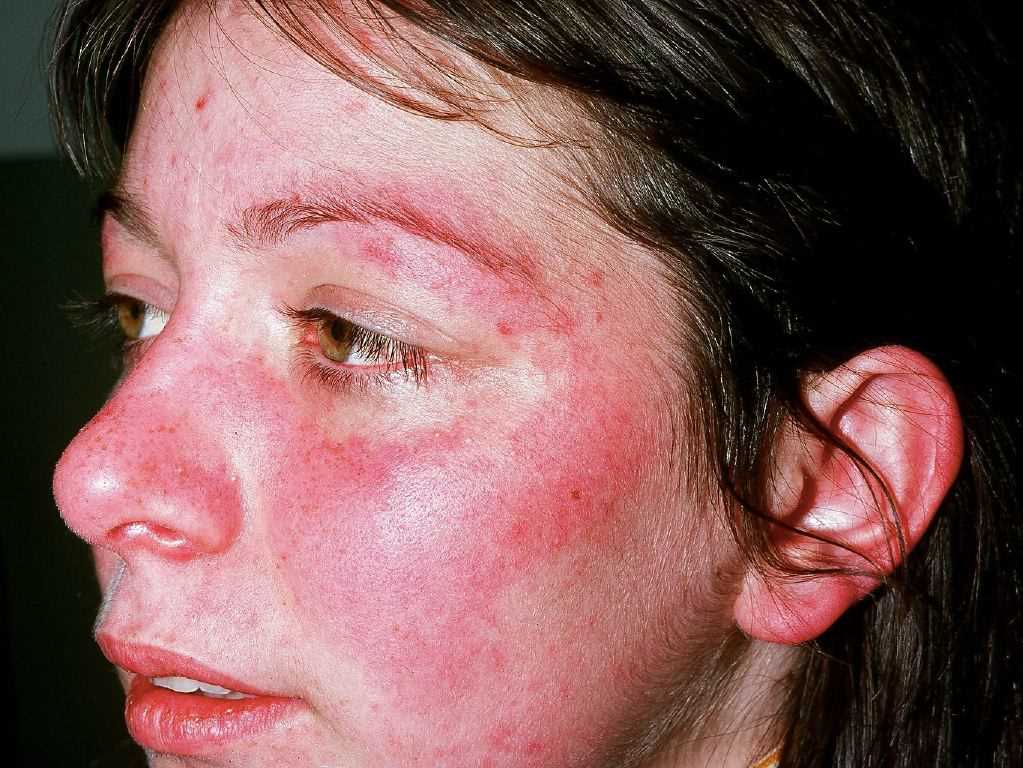 <p>Systemic Lupus Erythematosus</p>