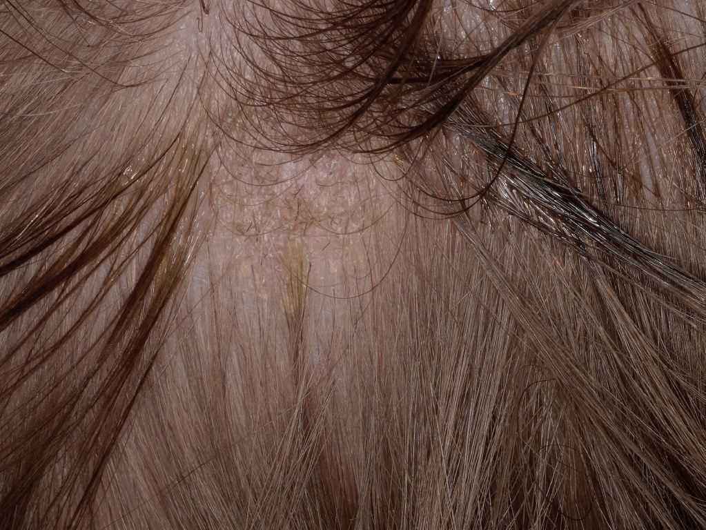 <p>Tinea Capitis</p>