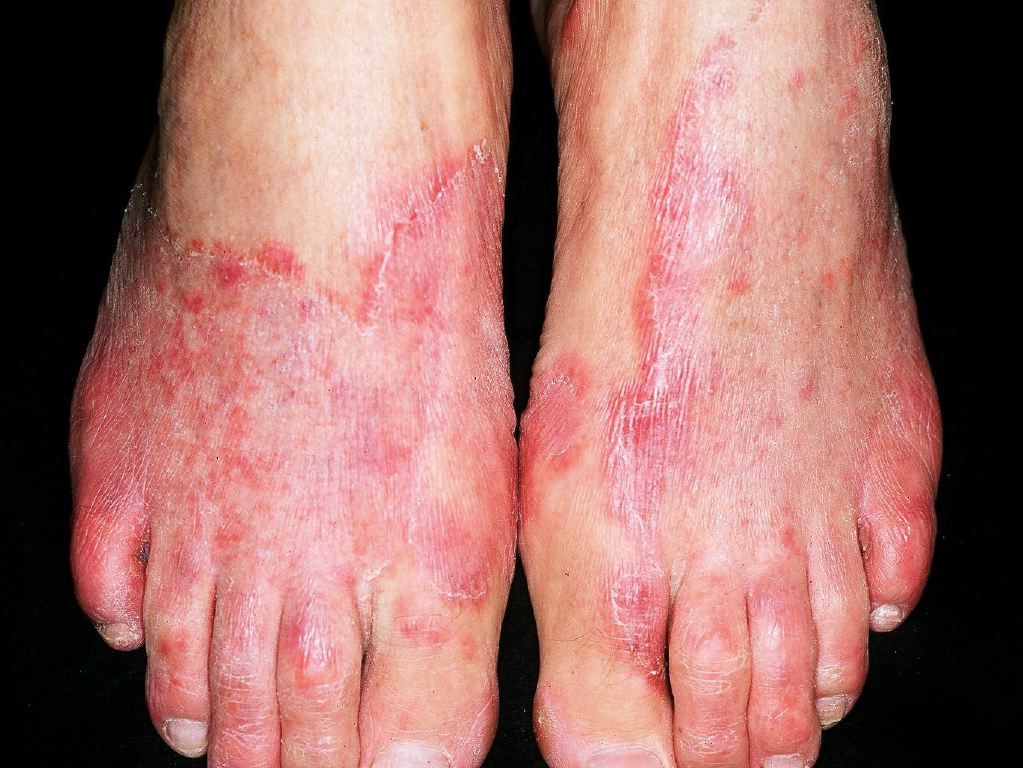 <p>Tinea Pedis</p>